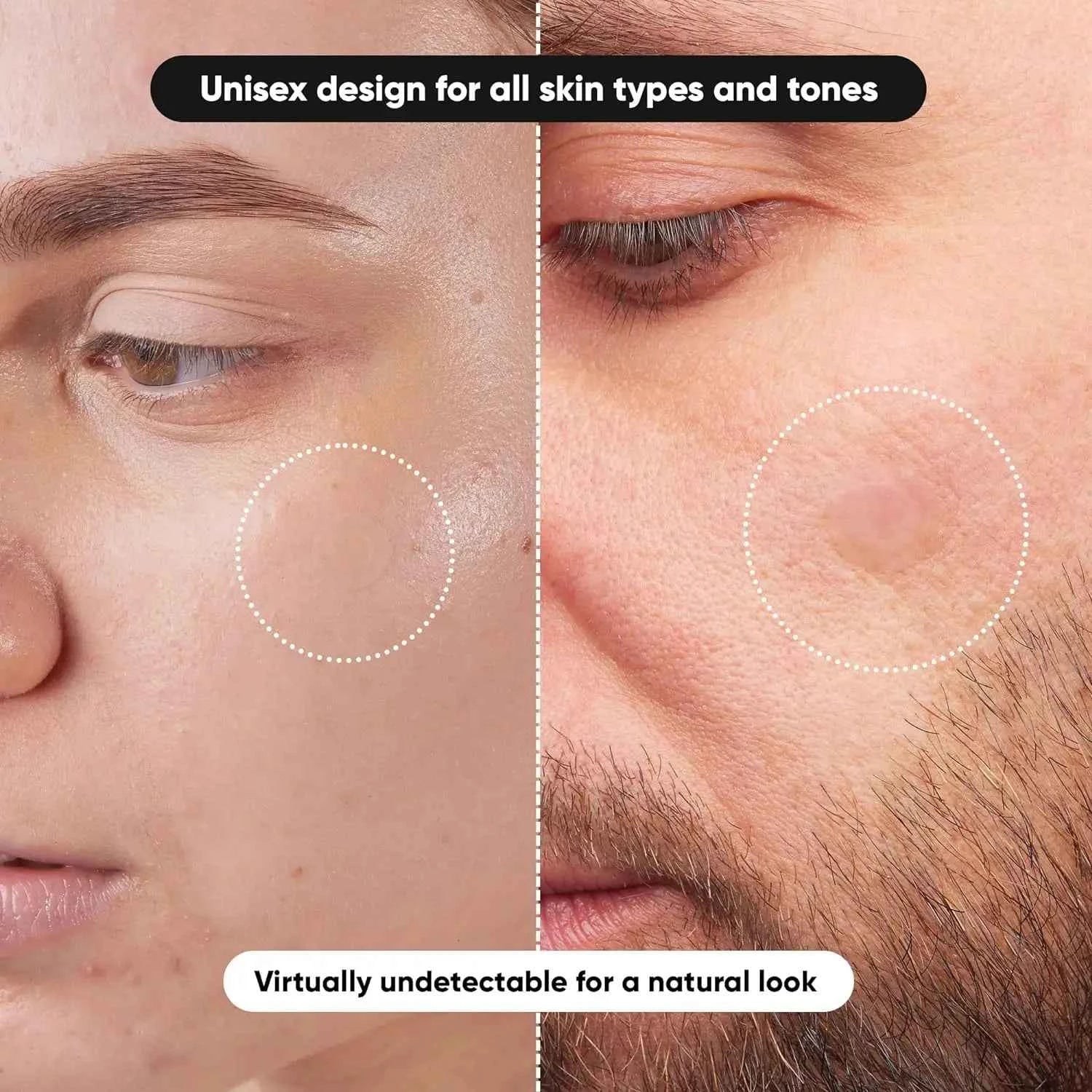 40/400 Pieces Hydrocolloid Acne Patches per Box Alcohol-Free Gentle Non-Irritating Blemish Covering Sticker for Pimples